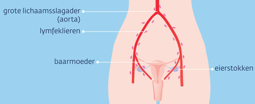 Meestal zitten de uitzaaiingen in de lymfeklieren in het kleine bekken en rond de grote lichaamsslagader (aorta).