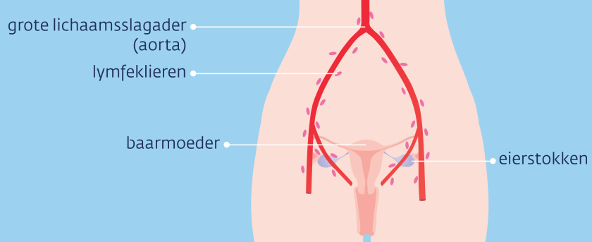 Meestal zitten de uitzaaiingen in de lymfeklieren in het kleine bekken en rond de grote lichaamsslagader (aorta).