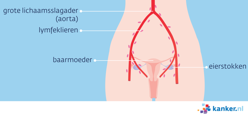 Meestal zitten de uitzaaiingen in de lymfeklieren in het kleine bekken en rond de grote lichaamsslagader (aorta).