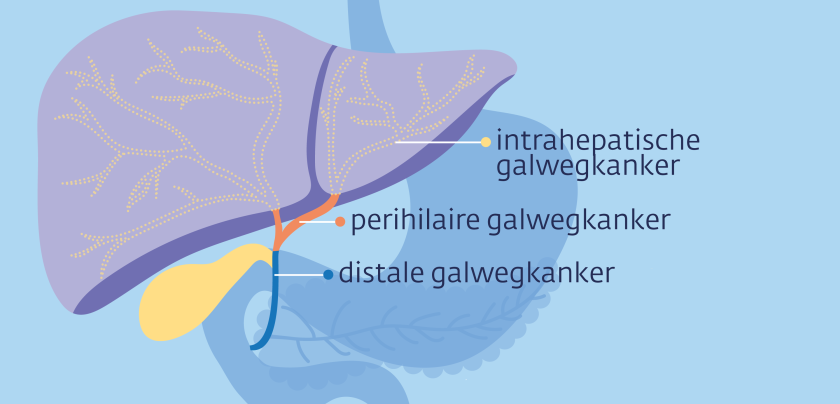 Er zijn drie verschillende soorten galwegkanker