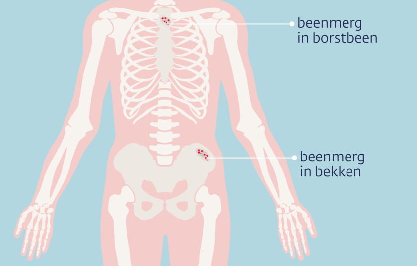 Beenmerg zit ondermeer in het borstbeen en het bekken