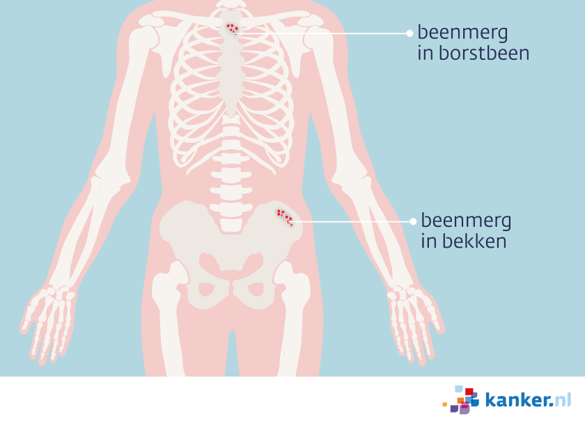 Beenmerg zit ondermeer in het borstbeen en in het bekken