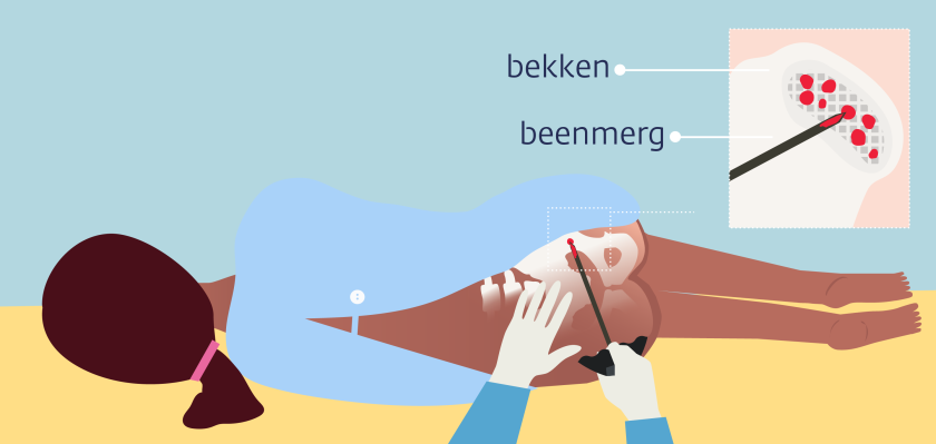 Bij een beenmergpunctie lig je op je zij en haalt de arts wat beenmerg weg uit je bekken
