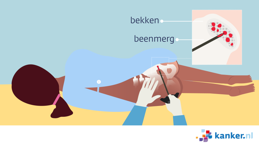 Bij een beenmergpunctie lig je op je zij en haalt de arts wat beenmerg uit je bekken.
