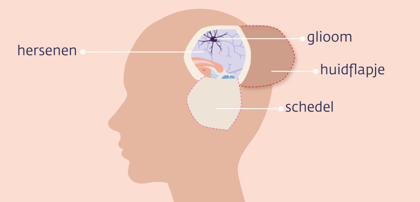 De neurochirurg scheert bij een craniotomie een stukje haar weg en maakt een soort luikje in de schedel.
