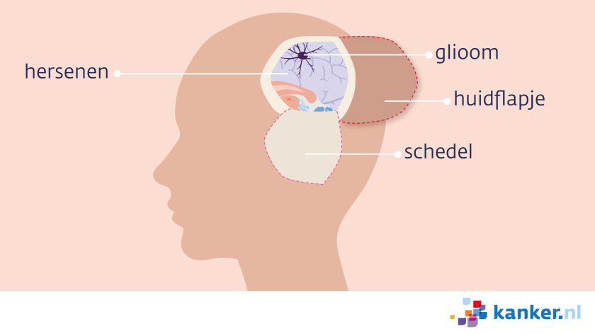 De neurochirurg scheert bij een craniotomie een stukje haar weg en maakt een soort luikje in de schedel.