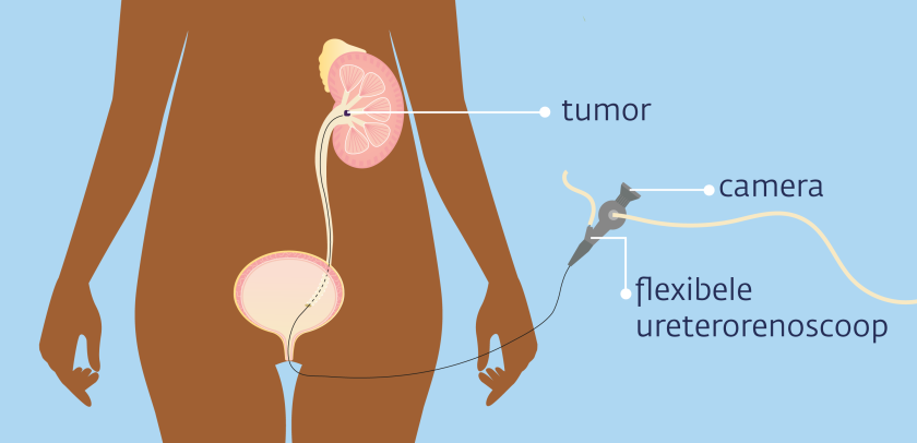De ureterorenoscoop gaat via de plasbuis en de blaas in de urineleider en naar het nierbekken. 