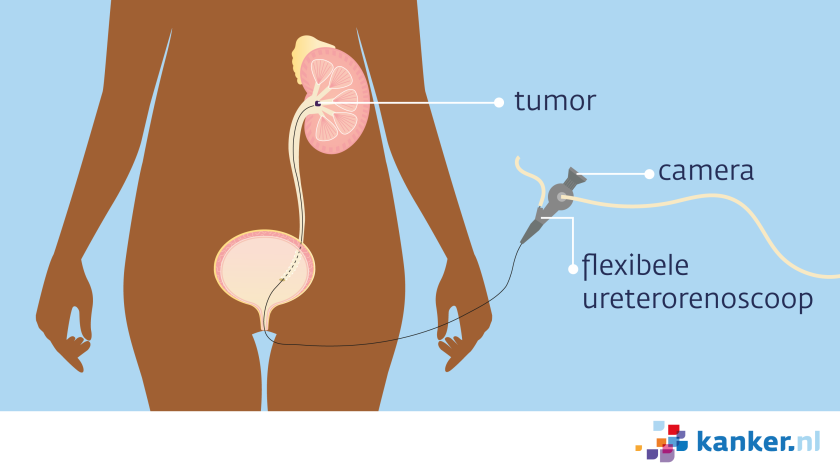 De ureterorenoscoop gaat via de plasbuis en de blaas in de urineleider en naar het nierbekken. 