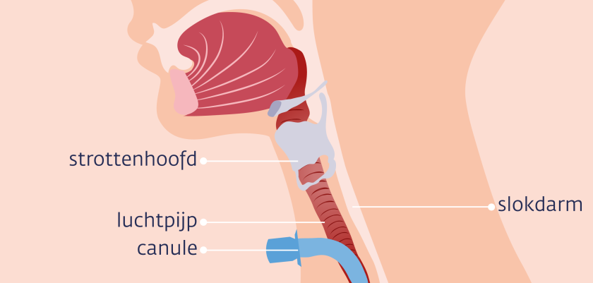 Bij een operatie voor sommige hoofd-halskankers krijg je een tracheotomie. Via de hals krijg je een buisje in de luchtpijp om adem te halen.