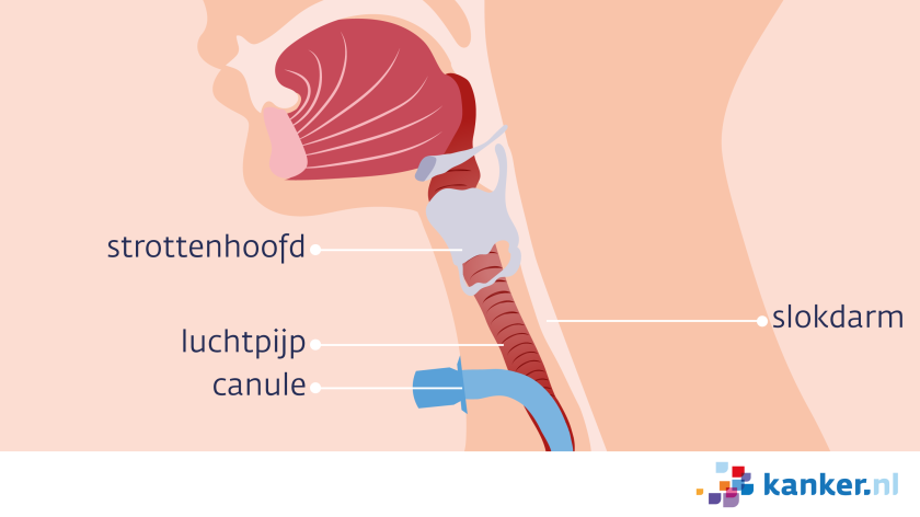 Bij een operatie voor sommige hoofd-halskankers krijg je een tracheotomie. Via de hals krijg je een buisje in de luchtpijp om adem te halen.