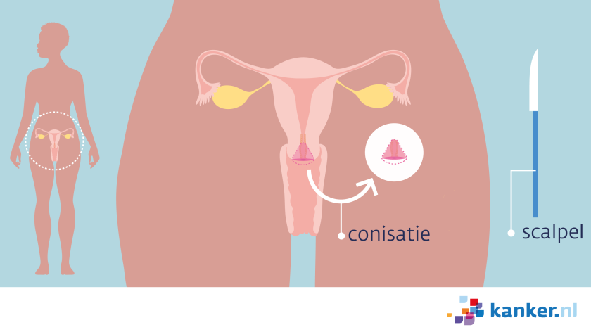 conisatie