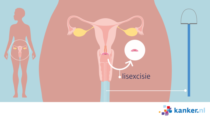 lisexcisie