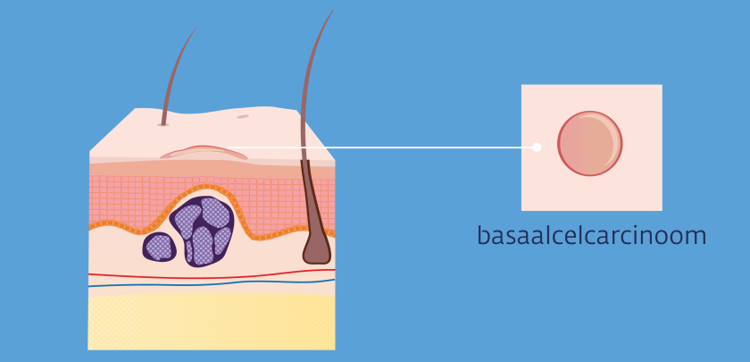 Een basaalcelcarcinoom lijkt aan de buitenkant vaak op een zweertje.