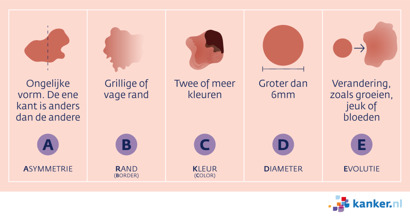 Uitleg ABCDE-regel om melanoom te herkennen.