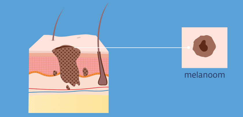 Een melanoom is een donker plekje dat door kan groeien tot in de lederhuid.