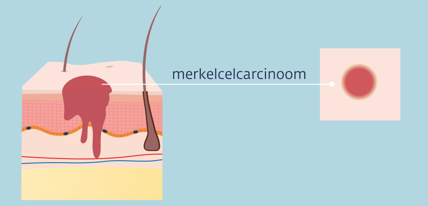 Een merkelcelcarcinoom kan doordringen tot de onderste huidlaag.