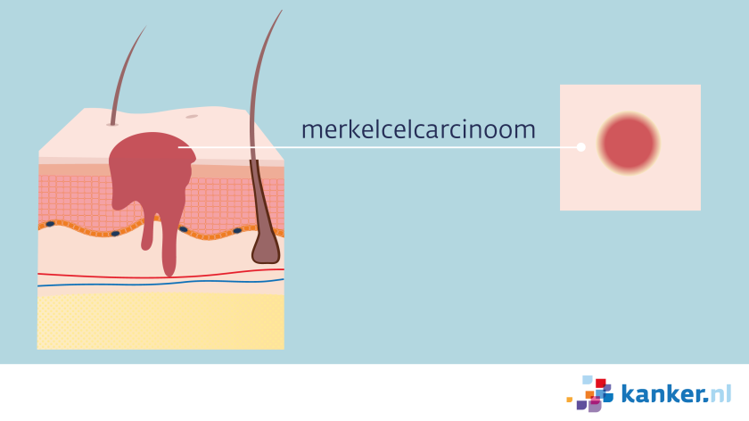 een merkelcelcarcinoom kan doordringen tot in de onderste huidlaag.