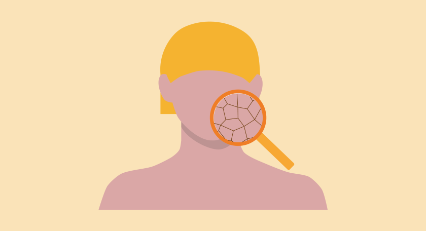 Illustratie van een gezicht waar voor een deel een vergrootglas overheen zit, dat ruwe huid laat zien.