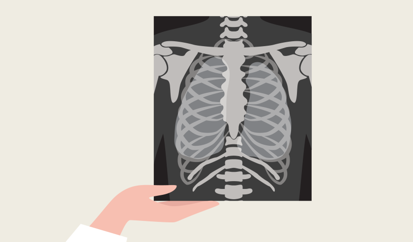 illustratie van een hand die een röntgenfoto van de borstkas, met daarin de longen zichtbaar, vasthoudt.