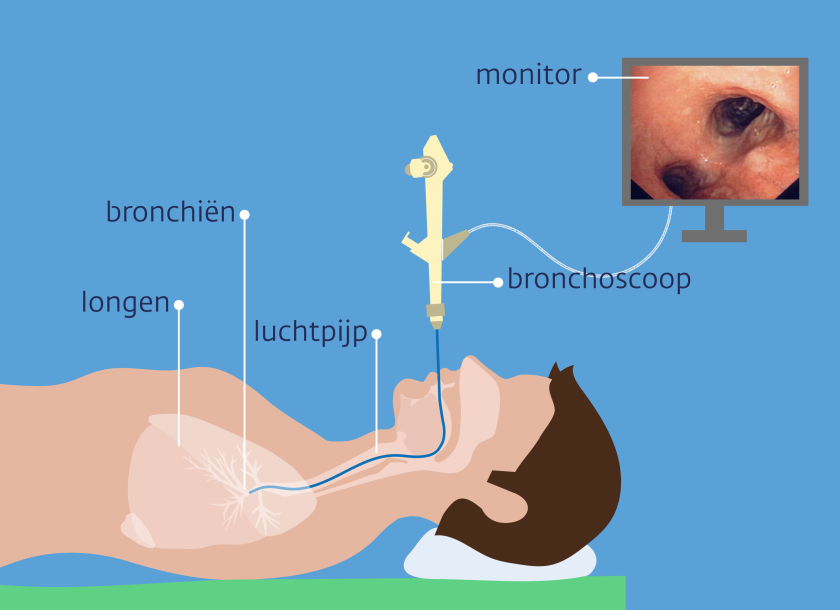 Bij een bronchoscopie brengt de arts een bronchoscoop via je mond of neus in de grote vertakkingen van je luchtpijp.
