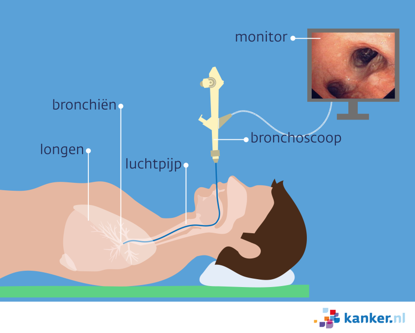 Bij een bronchoscopie brengt de arts een bronchoscoop via je mond of neus in de grote vertakkingen van je luchtpijp.