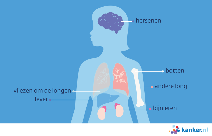 plekken waar longkanker naar kan uitzaaien