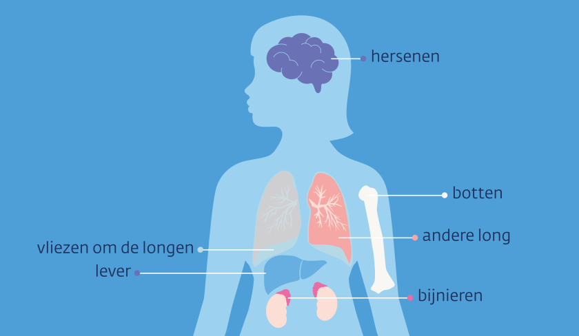 plekken waar longkanker naar kan uitzaaien