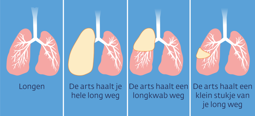 Bij een operatie bij longkanker kan je hele long weggehaald worden, of een longkwam, of een klein stukje van je long.