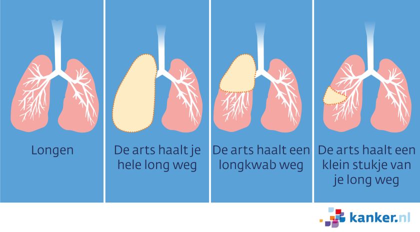Bij een operatie bij longkanker kan je hele long weggehaald worden, of een longkwam, of een klein stukje van je long.