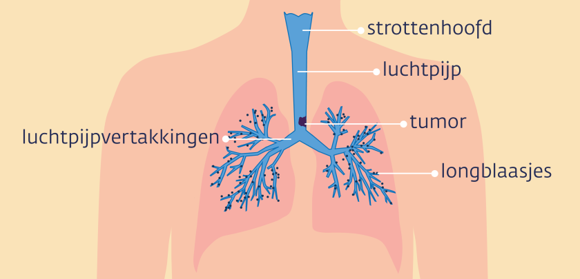 Illustratie van een bovenlijf met strottenhoofd, luchtpijp en de longen, met een tumor in de luchtpijp.