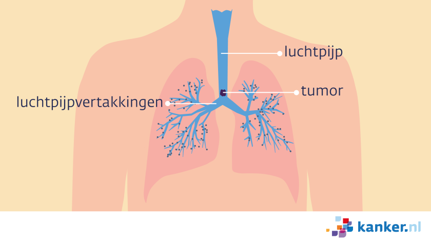 Illustratie van een bovenlijf met strottenhoofd, luchtpijp en de longen, met een tumor in de luchtpijp.