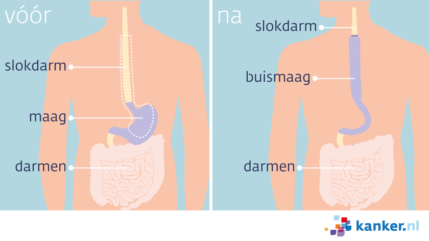 Bij een buismaagoperatie verwijdert de arts het onderste deel van de slokdarm en het bovenste deel van de maag weg.