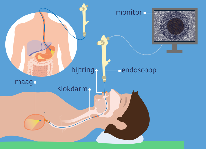 Bij een gastroscopie gaat de dunne slang van de endoscoop via je mond je lichaam in om de maag, slokdarm of dunne darm te bekijken.