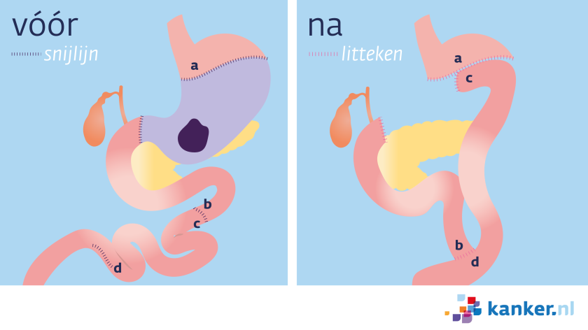 Bij maagkanker krijg je soms een partiële maagresectie. De arts verwijdert dan het onderste deel van de mag en een stuk van de dunne darm.