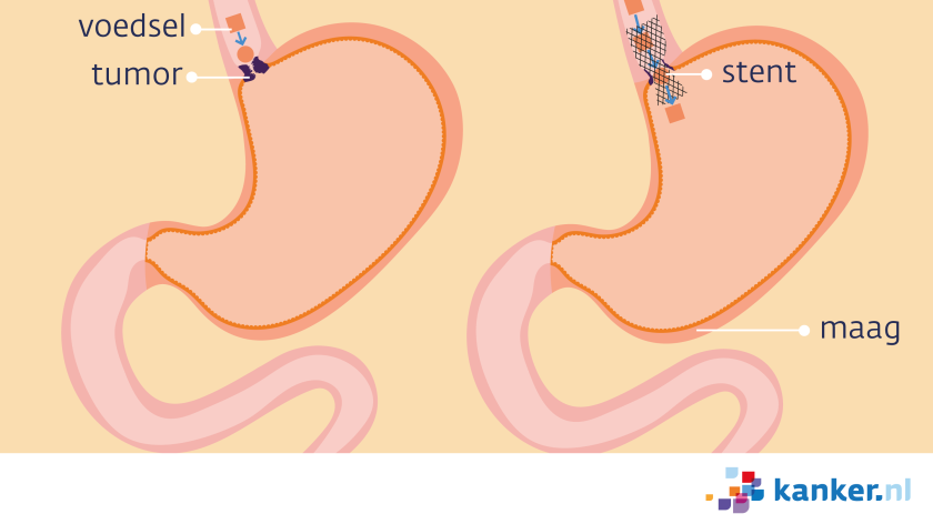 Als de tumor de maagopening blokkeert kan een stent zorgen dat de opening open blijft.