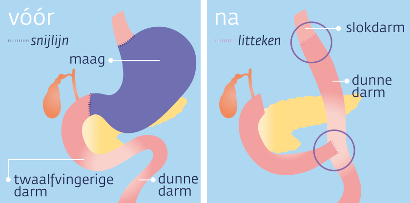 Bij maagkanker krijg je soms een totale maagresectie. De arts haalt dan de maag en de twaalfvingerige darm weg.