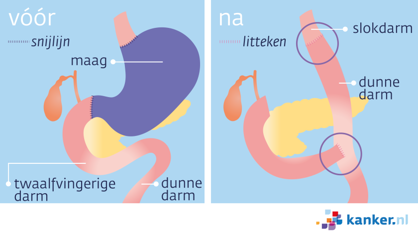 Bij maagkanker krijg je soms een totale maagresectie. De arts haalt dan de maag en de twaalfvingerige darm weg.