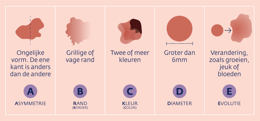 Uitleg ABCDE-regel om melanoom te herkennen.
