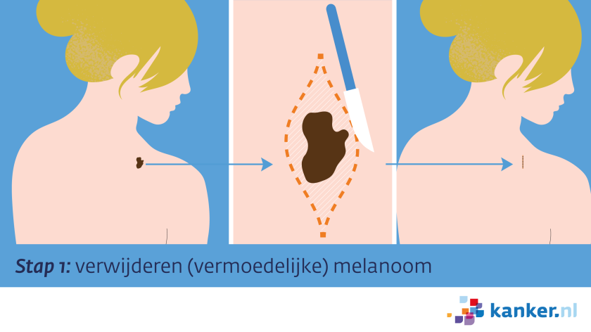 Excisie stap 1 - verwijderen vermoedelijke melanoom