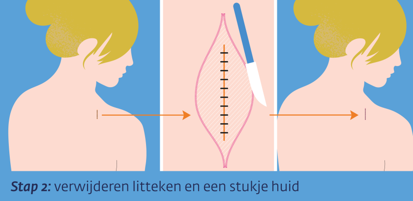 Excisie stap 2 - verwijderen litteken en een stukje huid