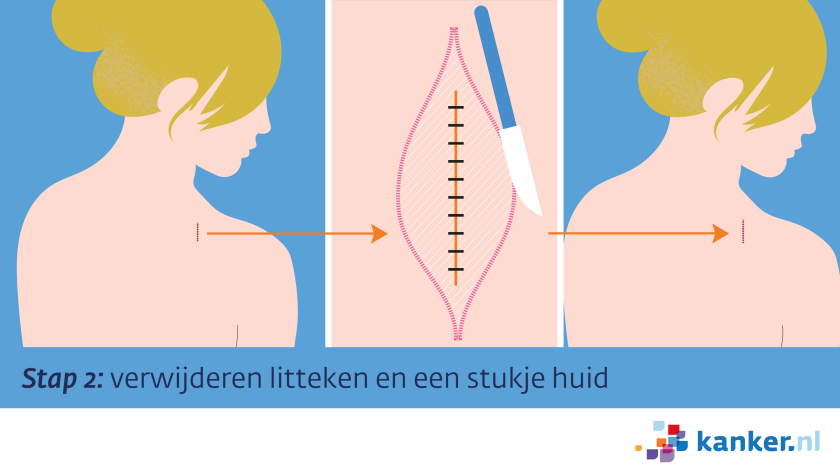 Excisie stap 2 - verwijderen litteken en een stukje huid