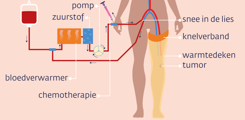 Bij een perfusiebehandeling van het been wordt je been gespoeld met verwarmd bloed, dat medicijnen (chemotherapie) bevat.