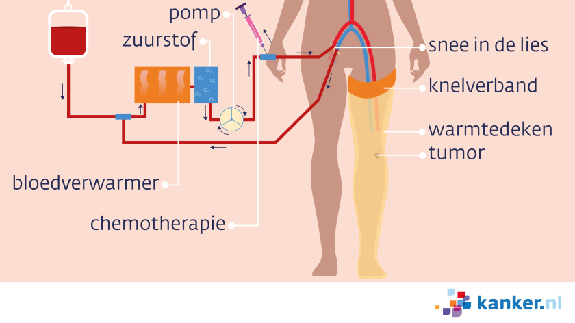 Bij een perfusiebehandeling van het been wordt je been gespoeld met verwarmd bloed, dat medicijnen (chemotherapie) bevat.