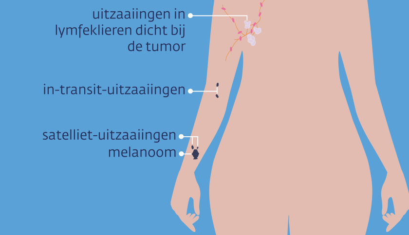 Uitzaaiingen van een melanoom op de arm kunnen satelliet of in transit uitzaaiingen zijn, of in lokale lymfeklieren zitten.