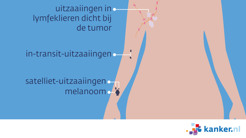Uitzaaiingen van een melanoom op de arm kunnen satelliet of in transit uitzaaiingen zijn, of in lokale lymfeklieren zitten.