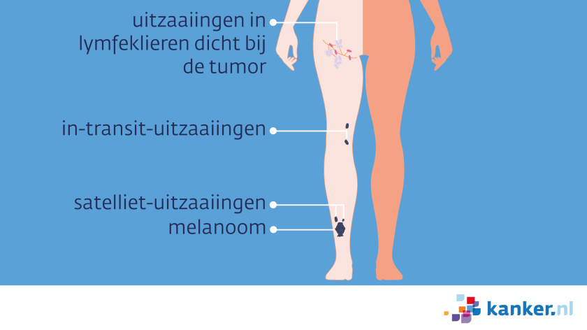 Uitzaaiingen van een melanoom op het been kunnen satelliet of in transit uitzaaiingen zijn, of in lokale lymfeklieren zitten.