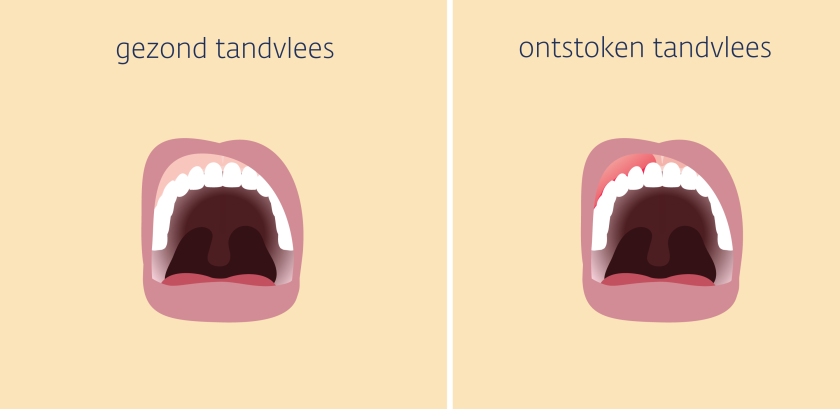 ontstoken tandvlees is vergeleken met gezond tandvlees donkerder van kleur