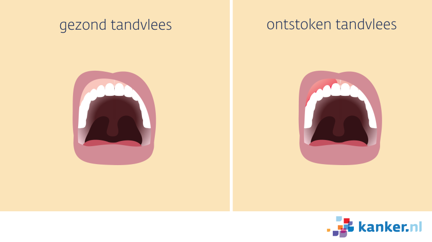 ontstoken tandvlees is vergeleken met gezond tandvlees donkerder van kleur