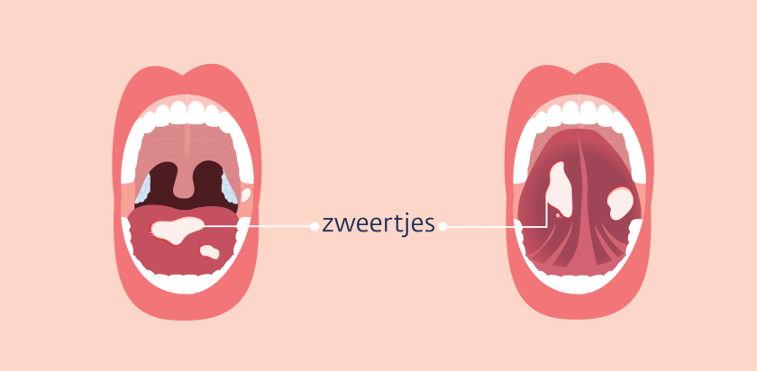 bij orale mucositis zitten er zweertjes aan de bovenkant en de onderkant van de tong