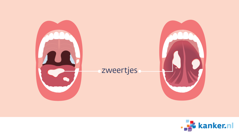 bij orale mucositis zitten er zweertjes aan de bovenkant en de onderkant van de tong